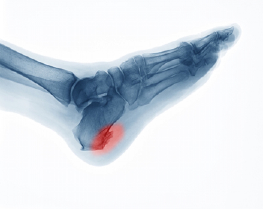 Bone spurs of the heel of foot defined and treatments